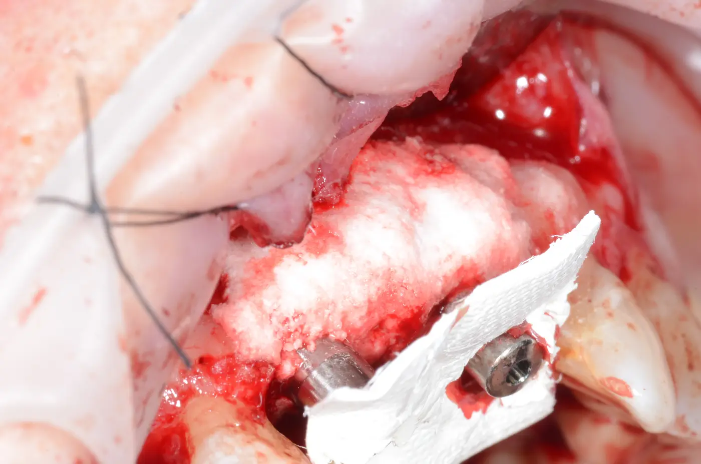 Aumento de reborde alveolar